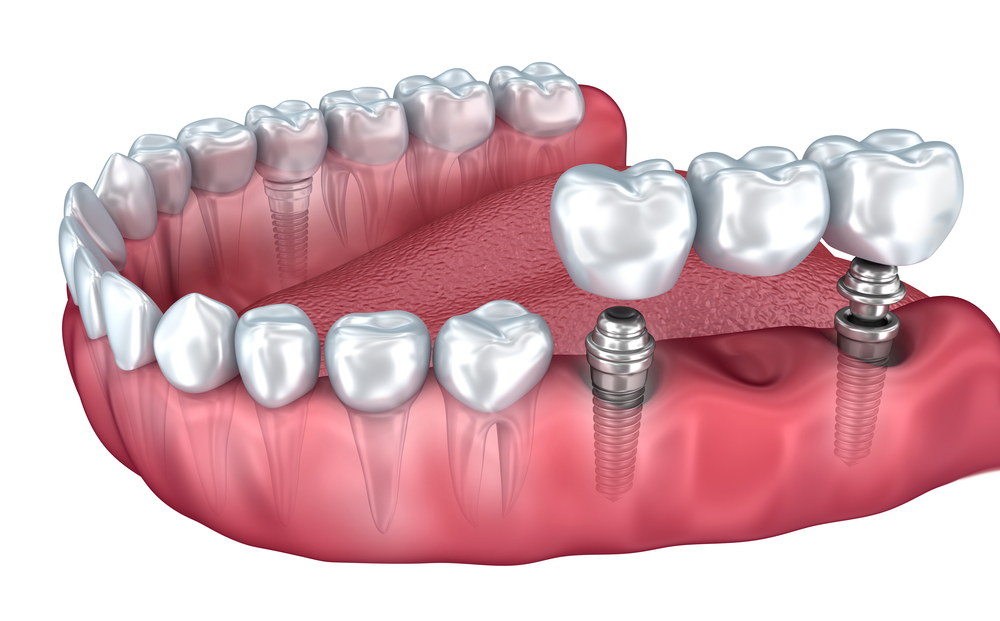 имплантация при отсутствии трех зубов