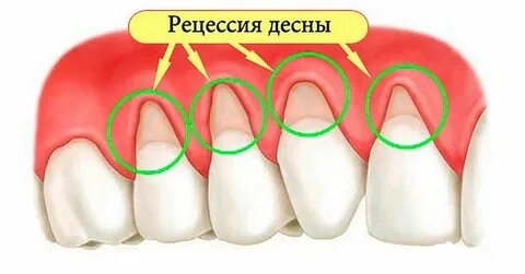 Гигиена при оголенных корнях зубов