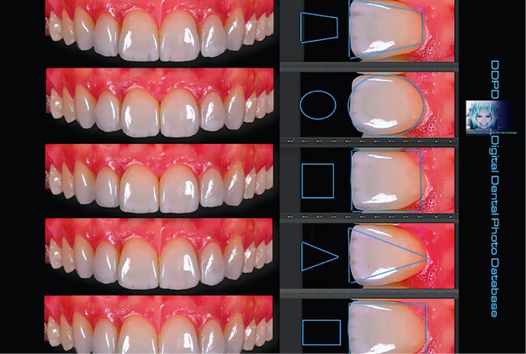подбор формы зубов при протезировании