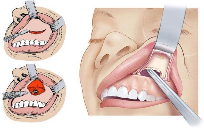 хирургическое лечение кисты зуба