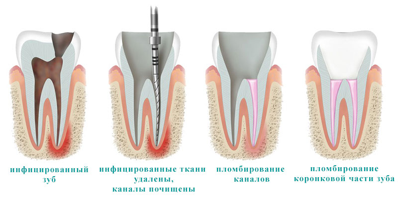 этапы лечения пульпита зуба