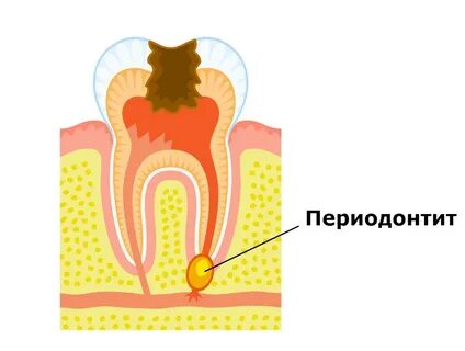 как выглядит периодонтит зуба