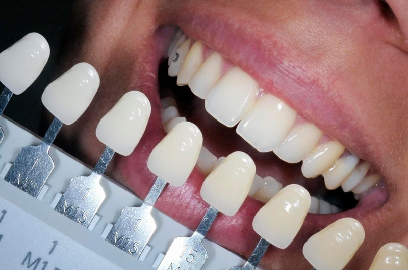 подбор цвета при протезировании зубов