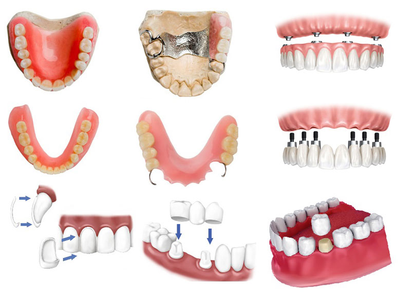 Примеры зубных протезов